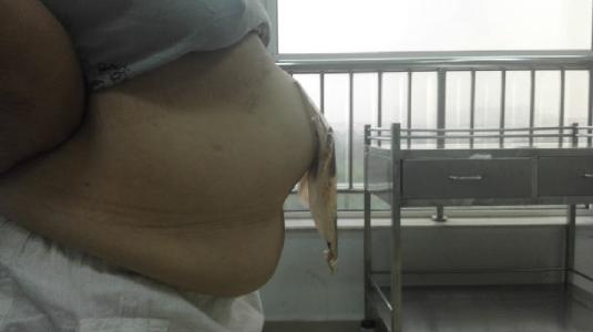 什么是人造肛门？为什么有的能还纳有的要带终身