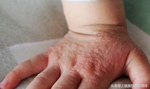 宝宝手上沙土皮炎怎么办,孩子手背沙土皮炎图片