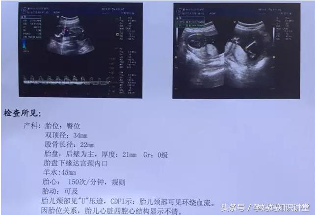 孕四个月的b超图怎么看,怎么看b超单判断胎儿怀孕