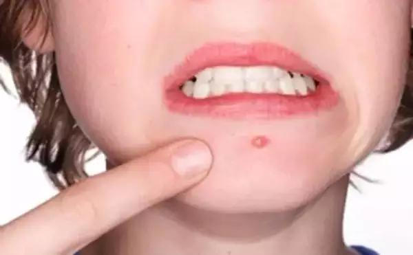 十年战痘血泪史详解,五年战痘经验分享