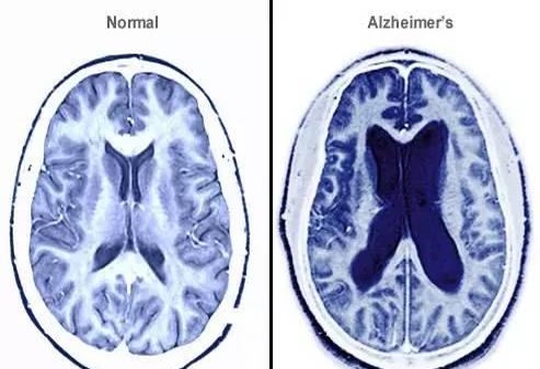 大脑橡皮擦现象,大脑有块橡皮擦