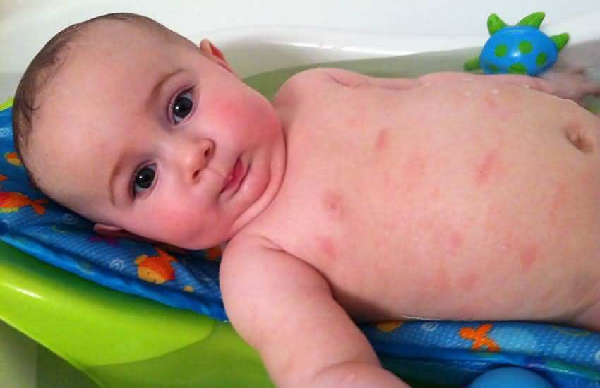 如何快速祛痱子湿疹,湿疹热疹痱子的区别