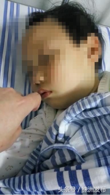 儿童腺样体肥大湖南哪家医院厉害,江西省儿童医院做腺样体肥大经历