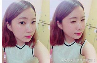 杭州美莱鼻综合最好的医生,杭州格莱美鼻尖整形怎样