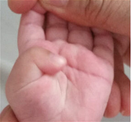 宝宝拇指内扣，可以这三种方法来纠正！