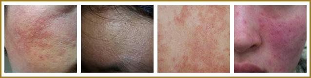 皮炎的几种常见类型介绍