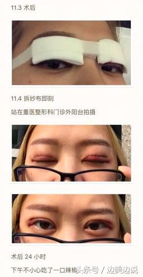 外科医生申霄,申霄医生双眼皮风格