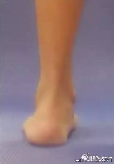 一只脚扁平足怎么矫正,瑜伽扁平足的矫正方法