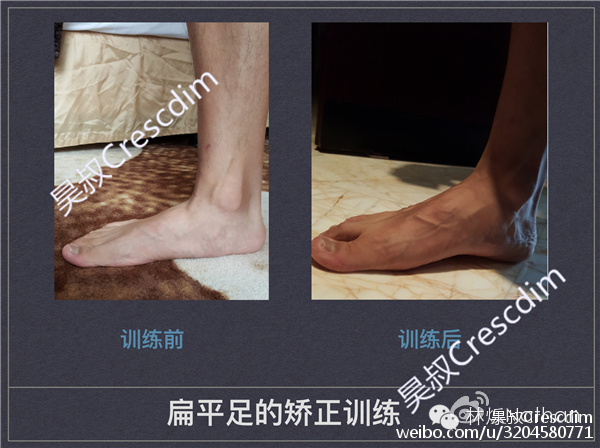 一只脚扁平足怎么矫正,瑜伽扁平足的矫正方法