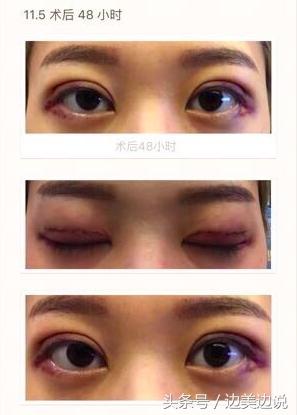 外科医生申霄,申霄医生双眼皮风格