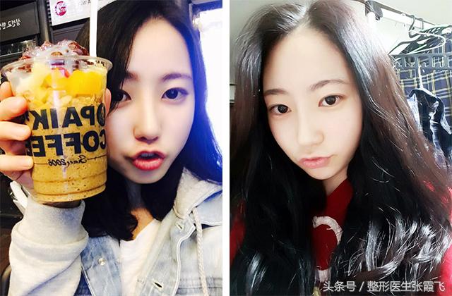 杭州美莱鼻综合最好的医生,杭州格莱美鼻尖整形怎样