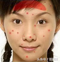 关于痘痘肌肤应该如何护肤,关于痘痘治疗方法