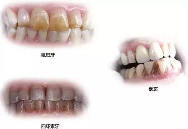 牙齿黄美白小妙招,牙齿黄怎么笑好看