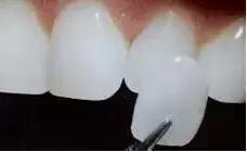 牙齿黄美白小妙招,牙齿黄怎么笑好看