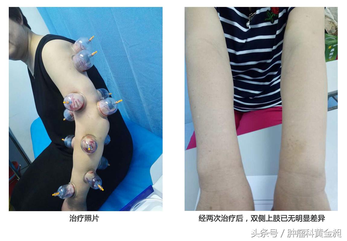 拔罐治疗乳腺增生结节,乳腺肿瘤拔罐