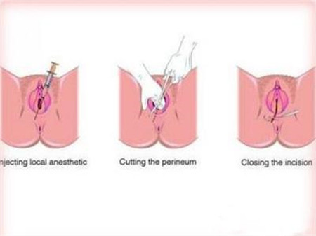 女人侧切伤口怎么护理愈合得快,顺产侧切伤口20多天了还疼怎么办