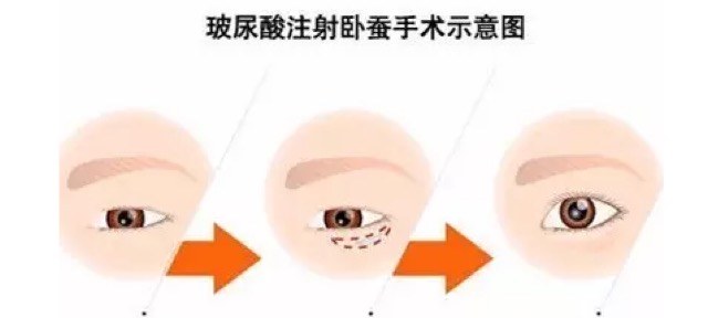 眼袋和卧蚕的区别看完你就知,卧蚕眼袋还在傻傻分不清楚