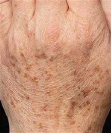 激光祛老年斑结痂13天不掉正常吗,老年斑用激光祛斑最有效方法