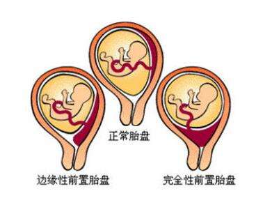 31岁孕妇在医院剖腹产,胎儿34周剖宫产取出可以存活吗