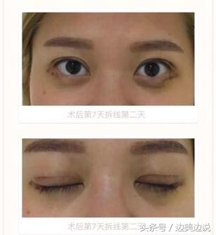 外科医生申霄,申霄医生双眼皮风格