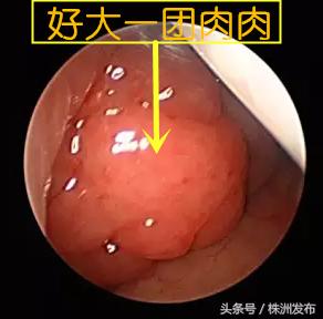 儿童腺样体肥大湖南哪家医院厉害,江西省儿童医院做腺样体肥大经历