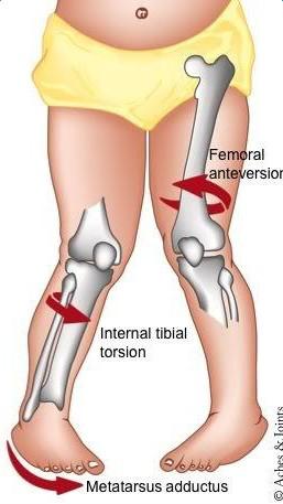 练习内八字走能纠正外八字走吗,外八字内八字怎么纠正