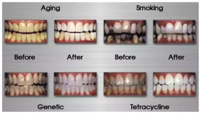 牙齿黄美白小妙招,牙齿黄怎么笑好看