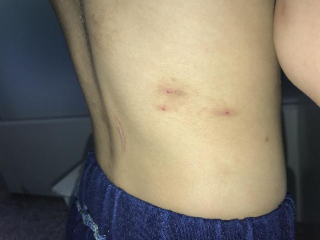 关于跳蚤叮咬人的三个小故事，也许你也经历过！