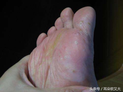 夏天脚气起水泡土方法,夏季脚气水泡
