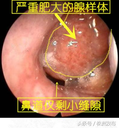 儿童腺样体肥大湖南哪家医院厉害,江西省儿童医院做腺样体肥大经历