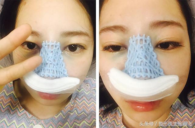 杭州美莱鼻综合最好的医生,杭州格莱美鼻尖整形怎样