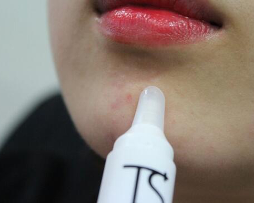 有什么方法防止脸部过敏,怎么预防春季脸上皮肤过敏