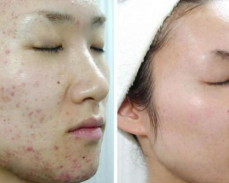 有什么方法防止脸部过敏,怎么预防春季脸上皮肤过敏