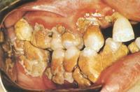 口腔里的细菌能杀菌吗,不刷牙口腔里的细菌