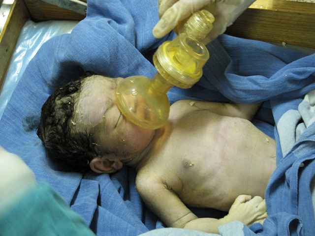 胎儿在肚子里为什么会吸入胎粪,胎儿在肚子里会不会拉屎尿尿