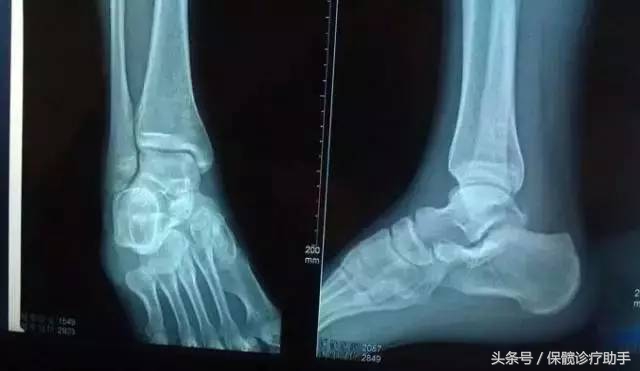 骨坏死与股骨头坏死一样吗,骨坏死和股骨头坏死是一个病吗