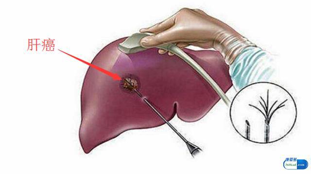 详解恩替卡韦治乙肝，避免肝癌一定要牢记这3点！