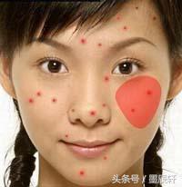 关于痘痘肌肤应该如何护肤,关于痘痘治疗方法