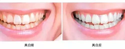 牙齿黄美白小妙招,牙齿黄怎么笑好看
