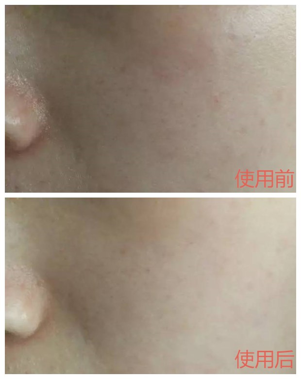 娜丽丝毛孔调理水,娜丽丝毛孔收敛水痘痘肌能用嘛