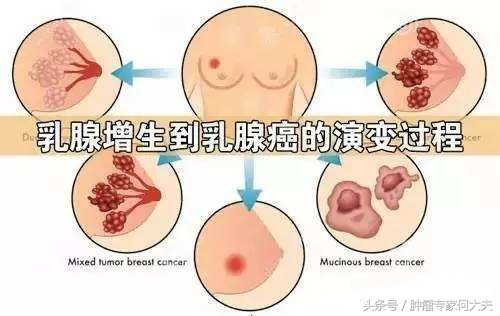 乳腺增生如何才能发展为乳腺癌,中医中药能治乳腺浸润性乳腺癌吗