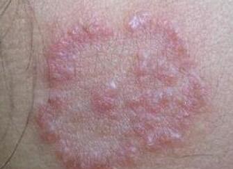 皮炎的几种常见类型介绍