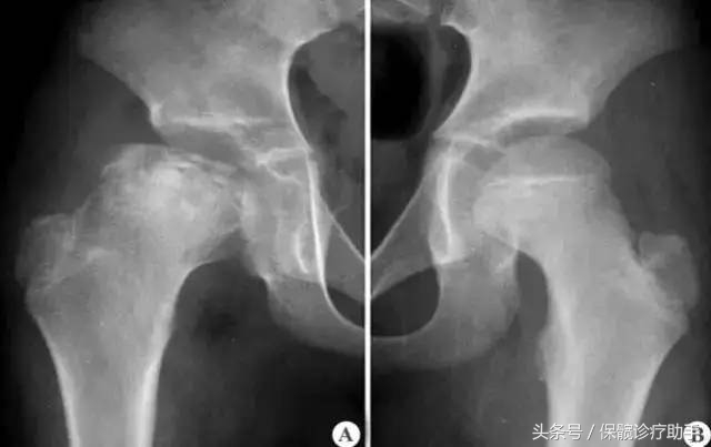 骨坏死与股骨头坏死一样吗,骨坏死和股骨头坏死是一个病吗