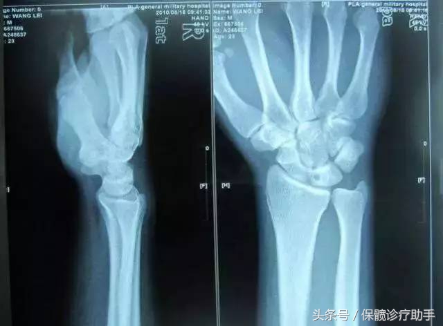 骨坏死与股骨头坏死一样吗,骨坏死和股骨头坏死是一个病吗