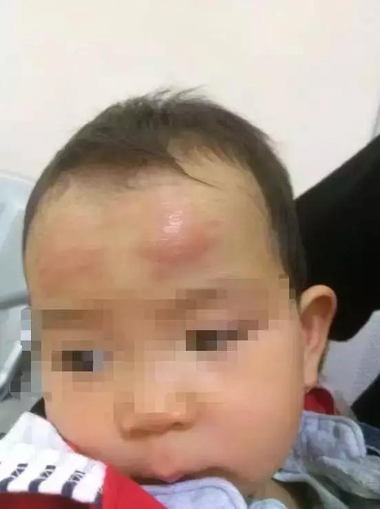 退热贴过敏会全身起红疹吗,退热贴过敏后额头爆皮