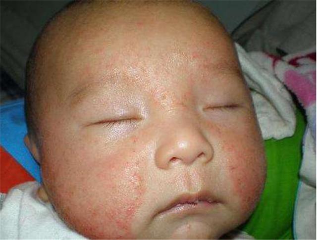 新生儿干性湿疹和湿性湿疹的区别,新生儿宝宝湿疹要怎么治疗