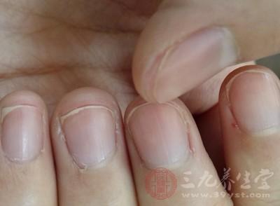 指甲上面有小白点怎么回事,指甲里的小白点是怎么回事