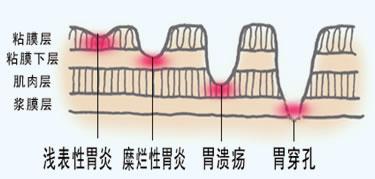 早餐吃不好最易得胆汁反流性胃炎,该怎么办?