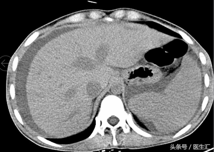 感染科可以治肝腹水吗,腹水被传染了怎么办