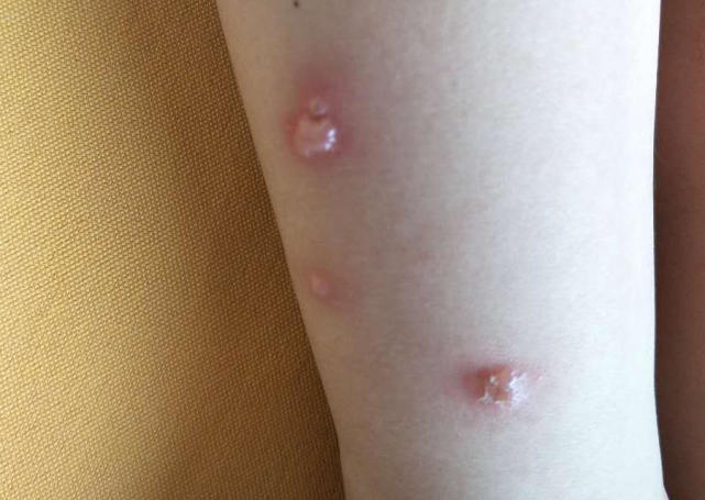 腿上被蚊子咬了留下的疤痕怎么祛,腿上被蚊子咬后留下的黑疙瘩图片